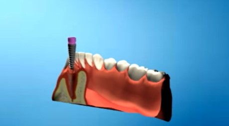 Tornillo para implantes dentales 