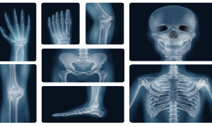 Gel inyectable surcoreano regenera huesos completamente y sin dolor en tiempo récord