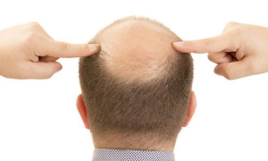 Nuevo tratamiento con Células “T” que ayudaría a regenerar el cabello perdido